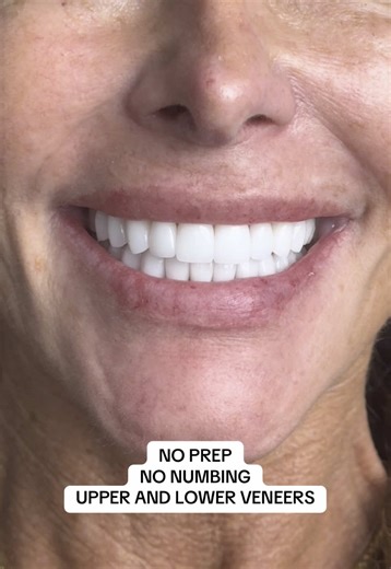 No Prep Veneers for a Smile Makeover
