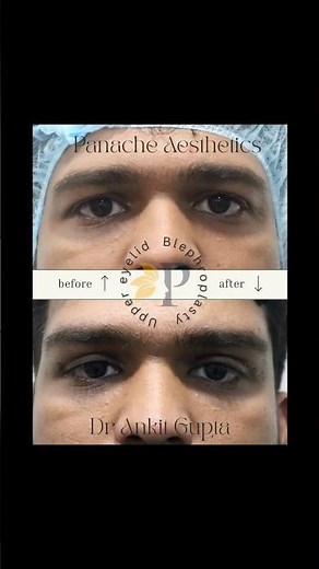 Upper eyelid Blepheroplasty with brow lift