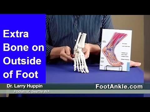Os Peroneum (Extra Bone Outside of Foot) | Seattle Podiatrist