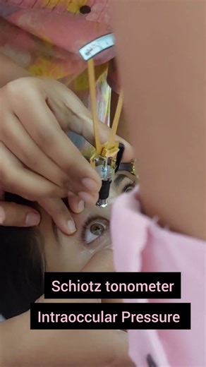 schiotz Tonometer