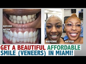 Get A Beautiful Affordable Smile (Veneers) In Miami!