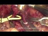 Laparoscopic Aneurismectomy with Direct Reconstruction of the Splenic Artery and Spleen Preservation • Video • MEDtube.net