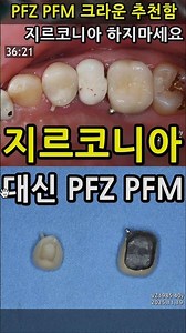 지르코니아 대신 PFZ PFM 크라운추천. 지르는 지옥. 대체품 하세요 2025_12_09 #pfz크리운