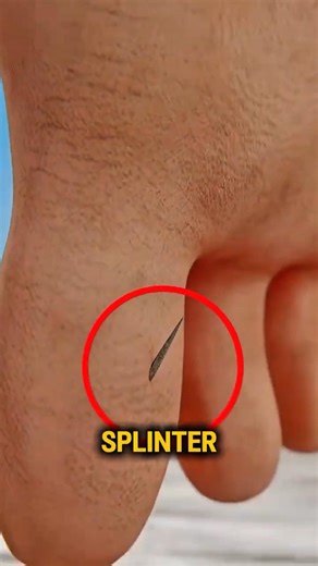 If You Ever Get a Splinter, Remove It the Safe Way