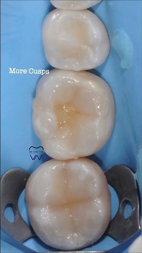 Class I Direct Composite Restorations Cusp by Cusp Build-up #adhesivedentistry