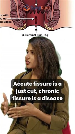 Laser Fissure Treatment | 📲 Free Consultation: +91 7670968977 | No Cost EMI | Surgikure