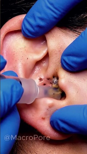Ear Vacuum Comedone Extraction. #dermatologyasmr