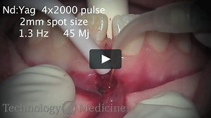 Frenectomy Using Both the Er_YAG & Nd_YAG Laser