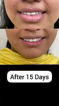 Lip Reduction surgery | Step by step | 15 Days Result