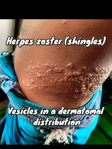 Herpes Zoster (Shingles)