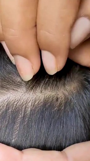 Lice squishing #fyp #longervideos #licetreatment
