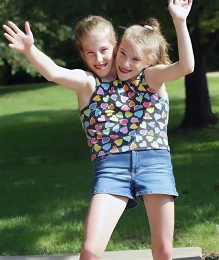 These sisters, conjoined twins, share one pair of arms, one pair of legs, and a common pelvis, but have two heads and separate internal organs 😢 Despite their unique anatomy, they have learned not only to walk and run, but also to swim, ride a bike, play the piano, and even drive a car 😱 One of the sisters has even gotten married and dreams of having a child 😱 How the sisters look today, and a photo of the husband, were shown in the first comment 👇👇 | Simple Living