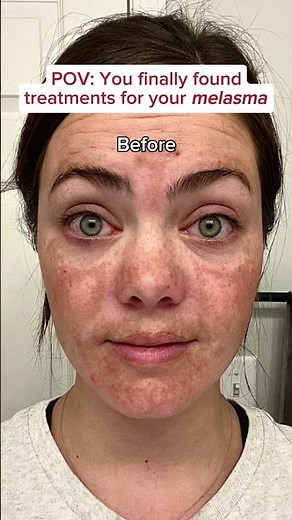 The BEST way to fade melasma? Pair together The Spot Cream and The Spot Pill 💕 #musely #melasma