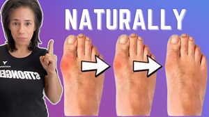11 reactions | In this video, Annette discusses how to Get Rid of Bunions  NATURALLY | Posturepro | Facebook