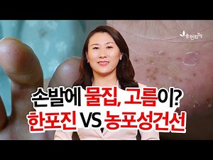 손발에 물집, 노란 고름이? 한포진 VS 농포성건선