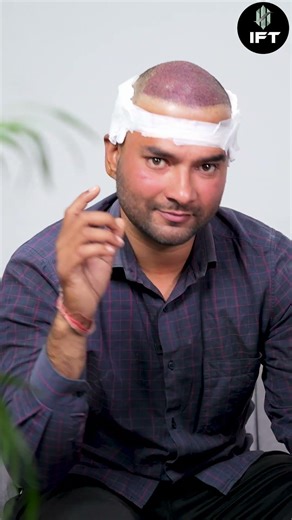 Best Hair Transplant In India? IFT Hair Science Answers
