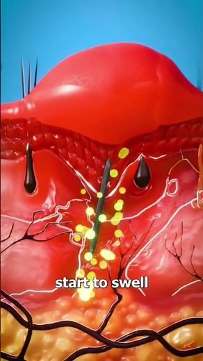 How Splinters Get Unstuck