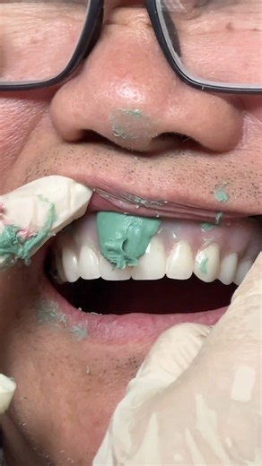 Refitting and Relining Process Dentures! Watch the full video on our YouTube channel at: https://youtu.be/AQz1vYwmYxA #reels #reelsinstagram #reel #youtubechannel #youtubevideo #youtubevideos #newyoutubevideo #premiere #dental #dentalart #dentalreels #dentist #dentistry #dentures #denture #DentalTech #dentaltechnician #DentalTechnology #video #videos #LSK121 #lsk121oralprosthetics #lukekahng | CEO Luke Kahng