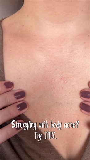 Salicylic Acid: Your Secret Weapon Against Body Acne