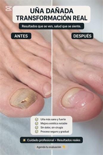 Transformación real de una uña dañada