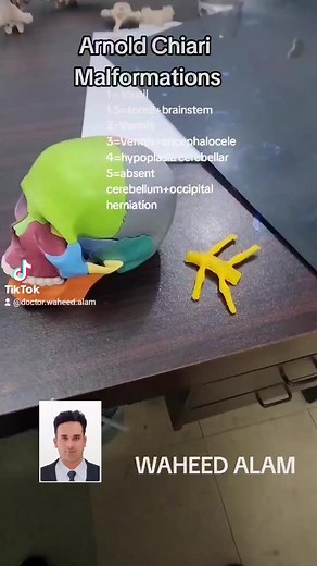 arnold chiari malformation | Dr.Waheed Alam's Neurosurgery Awareness Page