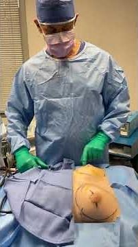 Liposuction + Gynecomastia - Male Chest Reduction in Milford, PA with Dr. Richard Buckley