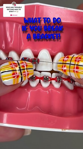 How to Keep Wax on Braces: Tips & Tricks for Orthodontic Care