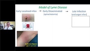 Clinical Pearls and Pitfalls of Lyme Disease