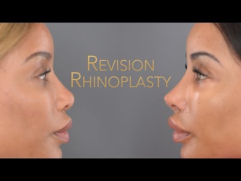 Barbie Nose Before And After Video | NOSE JOB TRANSFORMATION | Revision Rhinoplasty Surgery