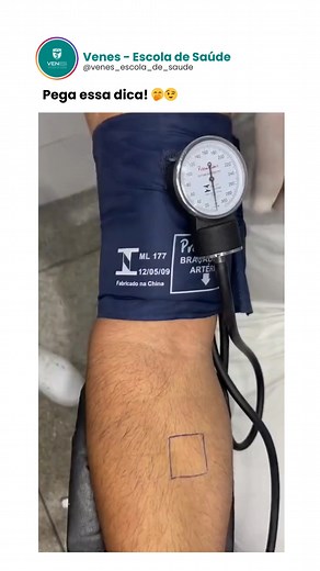A prova do laço é um teste rápido utilizado para avaliar a fragilidade dos vasos sanguíneos. É comumente aplicado em casos suspeitos de dengue para identificar o risco de sangramento. O teste é feito inflando um manguito de esfigmomanômetro no braço do paciente até um valor médio entre a pressão arterial máxima e mínima, mantendo-o por cinco minutos. Após desinflar o manguito, observa-se a presença de petéquias (pontinhos vermelhos) na área testada. Um resultado positivo, indicando mais de 20 pe