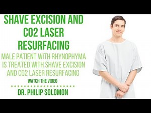 Rhynophyma treated with Shave Excision and CO2 Laser Resurfacing | Dr. Philip Solomon