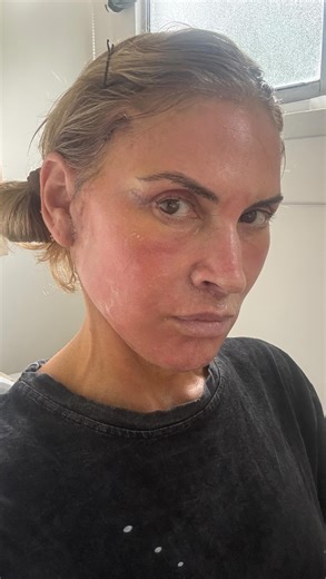 Emily Wagner on Instagram: "This was yesterday. Day 5 Post op with @drpatrickkdavis. Deep Plane face and neck lift, temporal brow, upper bleph, lip lift, CO2 and heyyyy all the fat transfer girlies (I see you my Korea globe trotting friends) come to the front of the line! More deep and not so deep thoughts and radical non bullshit rambles an a heated rivalry Easter egg, while getting my first real face wash on yesterday. Wow what felt good. I’m on Day 6 today - feeling amazing - and tomorrow I g