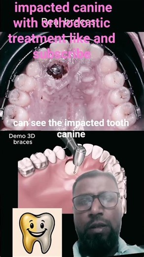 impacted canine orthodontic alignment procedure😱😁😷😬✅# shorts #feeds#