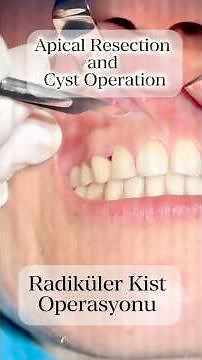 Apical resection and cyst operation.