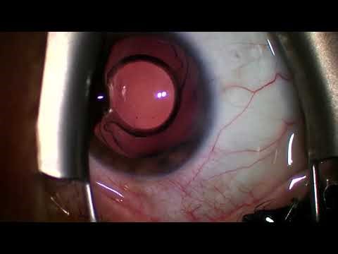 2025 09 11 095017 IOL Exchange Odyssey to Panoptix Pro