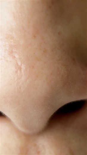 neuroradhunt on Instagram: "Answer to the previous reel 👉 Rhinophyma Rhinophyma is clinically relevant not only for its nasal deformity, but also because of its potential association with malignancy. 🧲 Patients with rhinophyma carry a 3–10% increased risk of basal cell carcinoma. For this reason, MRI evaluation is important to assess for possible underlying pathology. In this case, no suspicious lesion was identified — the findings were consistent solely with rhinophyma, without any areas of a