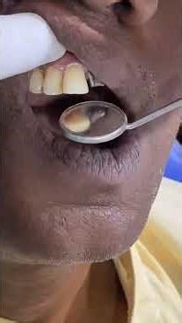 single anterior tooth replacement with implant