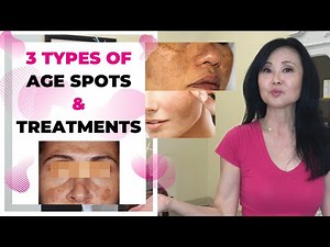 Age Spots vs Skin Cancer- 3 Types