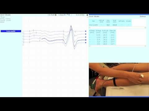 Réflexe de Hoffmann (racine S1)