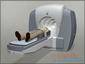Neurology animation - Gamma Knife Surgery