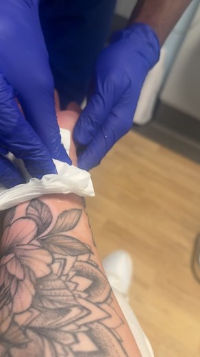 Understanding Burn Blisters: Healing and Care Tips