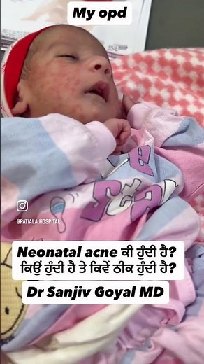 What is neonatal acne ?