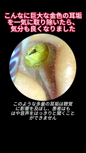 Satisfying ASMR Ear Cleaning and Wax Removal - Gentle Sounds