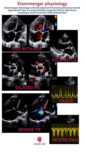 EchoDx Hub 🫀 on Instagram: "🫀 Echo Case of the Day 23-year-old male | Large sub-aortic VSD 🔹 Large non-restrictive sub-aortic VSD 🔹 Bidirectional shunt on color Doppler 🔹 Severe pulmonary arterial hypertension (TR Vmax ≈ 4.1 m/s) 🔹 Severe tricuspid regurgitation 🔹 Severe RV and LV systolic dysfunction 🔹 Dilated coronary sinus (↑ RA pressure) 🧠 Echo interpretation: Findings are suggestive of Eisenmenger physiology due to long-standing VSD with advanced pulmonary vascular disease. ⚠️ Teac