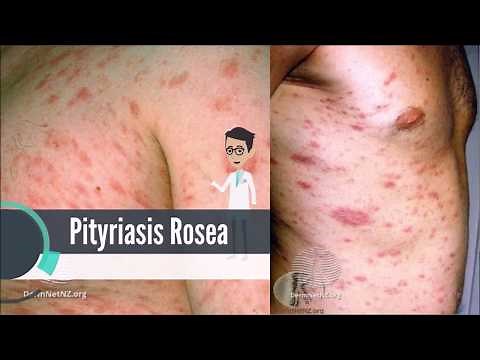 What is Pityriasis Rosea?