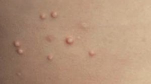 Molluscum  Contagiosum – Pictures, Symptoms, Causes, Treatment