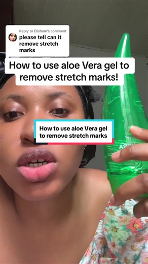 How to Remove Stretch Marks with Aloe Vera Gel