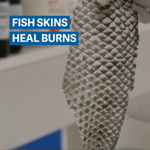 Doctors in Brazil are using fish skin—which is usually a waste product—to heal human skin. | Quartz