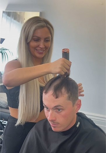 Scalp Micropigmentation for Natural Hairline Restoration