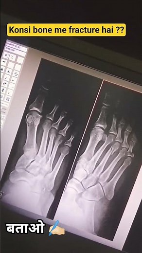 Kon si bone 🦴 mai fracture hai ? ✍🏻✍🏻xray foot 🦶🏻 ap oblique #xray #radiography #fractured